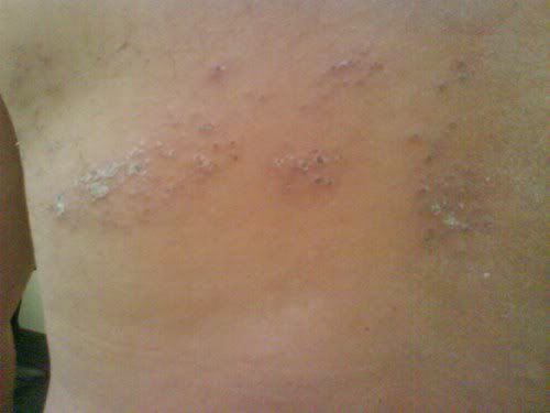tratar dor por herpes zoster com acupuntura